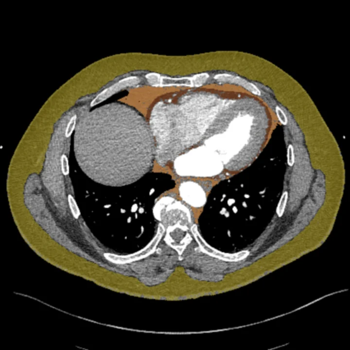 Paired chest CT with segmented adipose depots