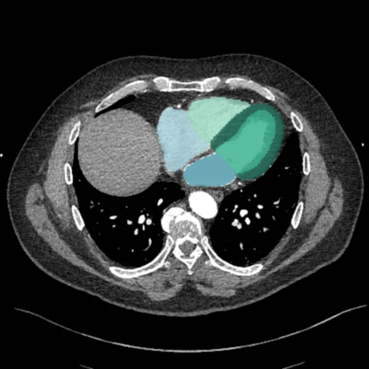 Paired chest CT with segmented cardiac chambers
