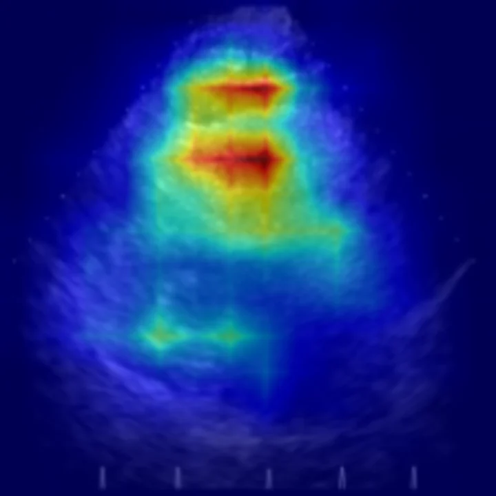 PanAdipo attention map over the same echocardiogram