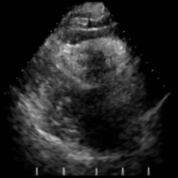 Transthoracic echocardiogram, parasternal view