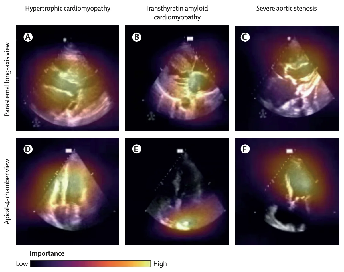 Lancet Digital Health 2025 POCUS figure