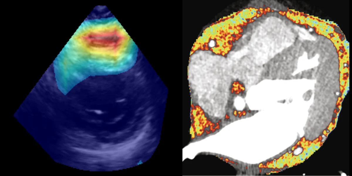 PanAdipo attention over the epicardium on echocardiography, and epicardial fat attenuation mapped on cardiac CT