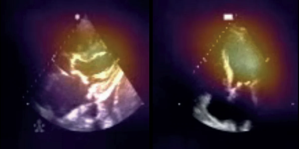 Saliency maps over echocardiographic views in severe aortic stenosis