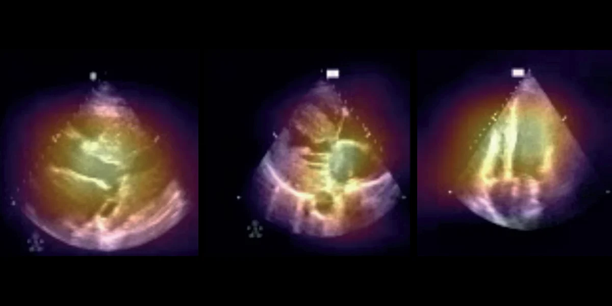 Saliency maps over point-of-care echocardiograms in hypertrophic and transthyretin amyloid cardiomyopathy