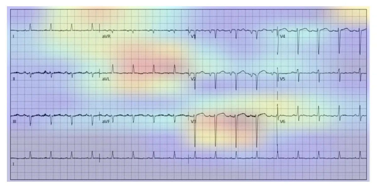 AI-ECG attention map on a surveillance electrocardiogram